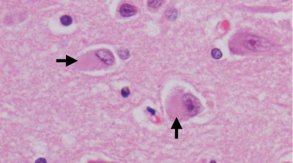 Dementia with Lewy bodies under the microscope